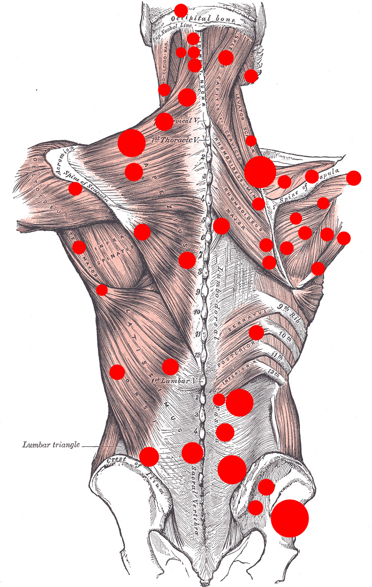 Myofascial trigger points on the back